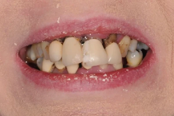 Full Mouth Implants