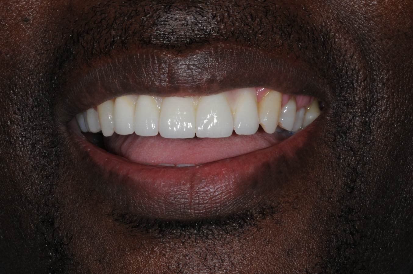 Implant supported bridge replacing missing teeth, fitted at Love Implants Colchester