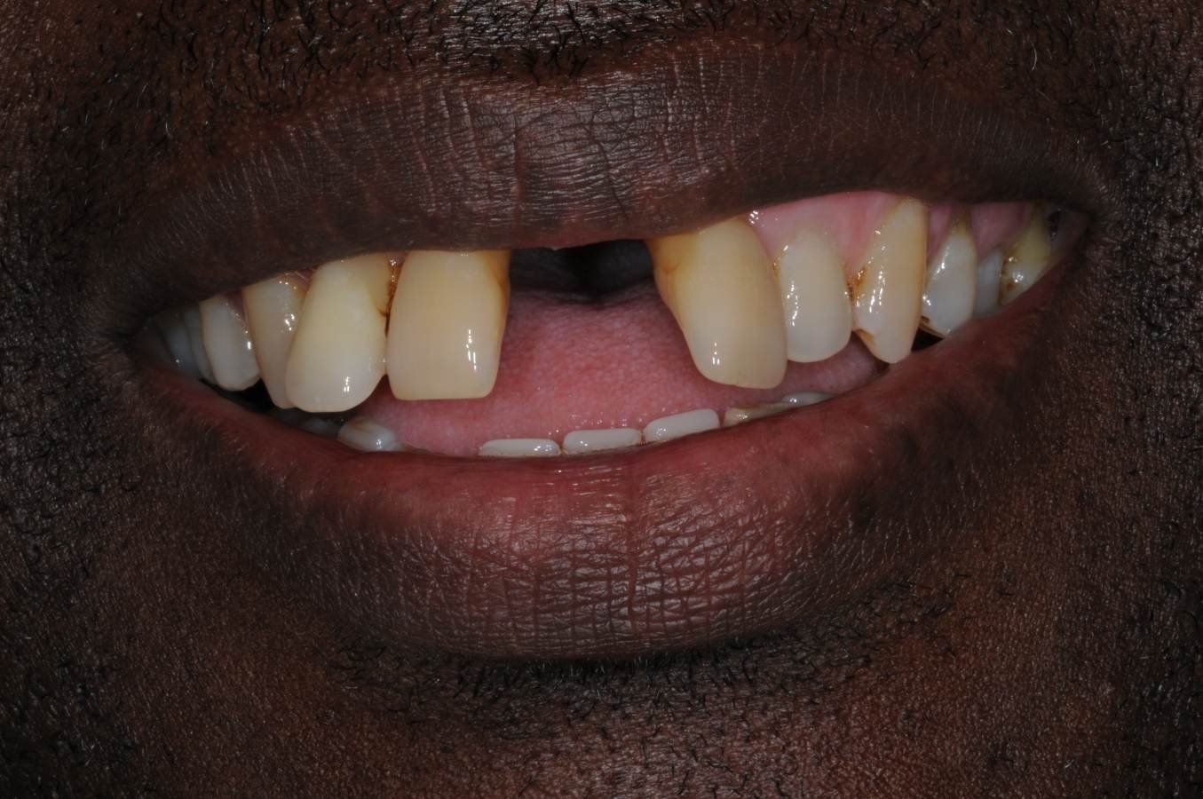 Gap from missing teeth in a row before implant supported bridge in Colchester