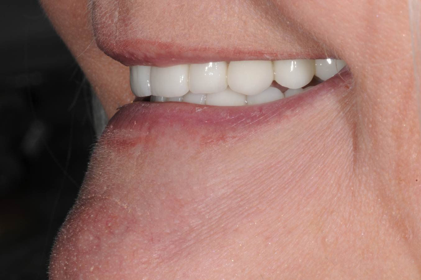 Front teeth restored with crowns and missing back teeth replaced with implants, Love Implants Colchester