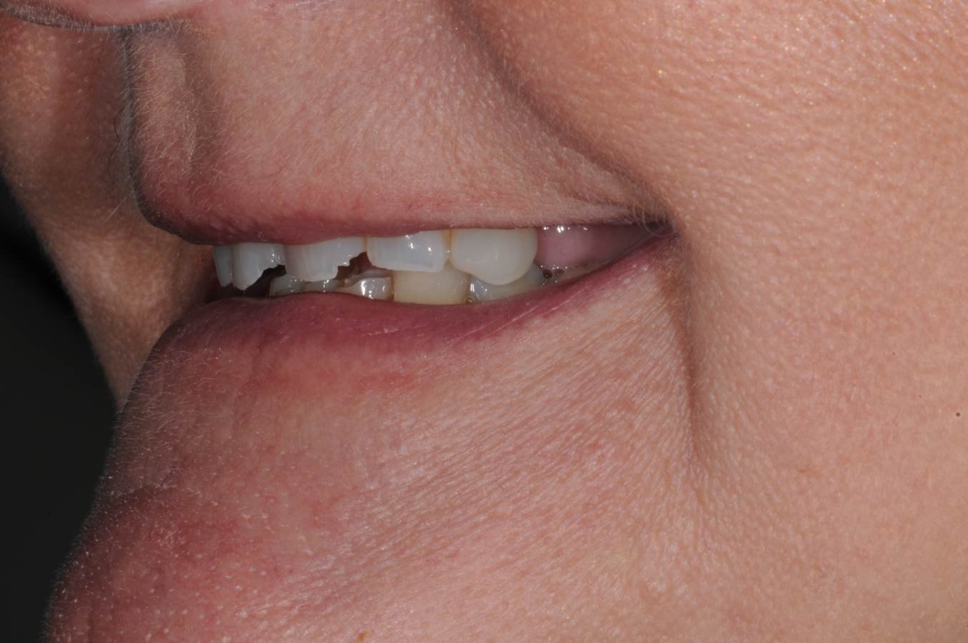 Chipped worn front teeth and missing upper back teeth before implant treatment in Colchester
