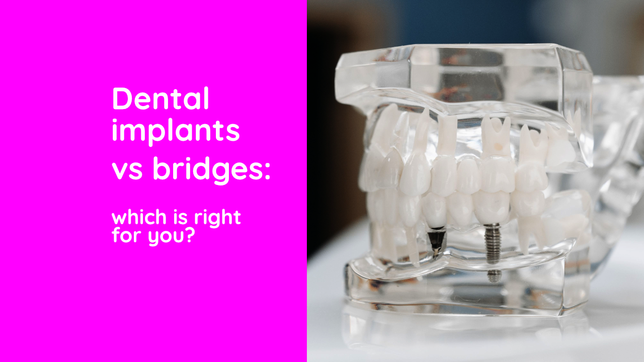 Clear acrylic dental model showing two dental implant screws anchored in the lower jaw beneath natural-looking crowns