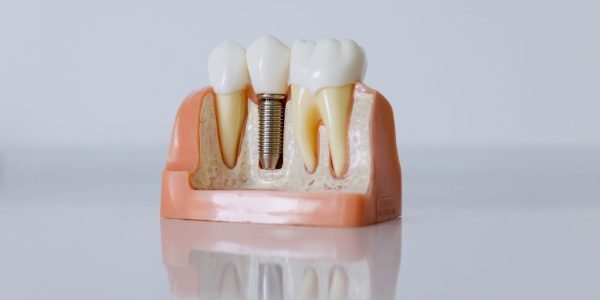 Cross-section dental model showing an implant post fitted in the jawbone beside two natural teeth